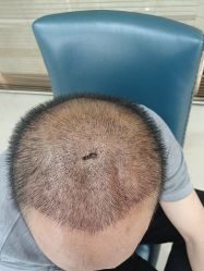 -大麦微针植发丨全国连锁