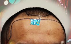 -大麦微针植发全国连锁