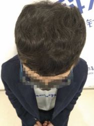 点击看大图 -大麦微针植发丨全国连锁