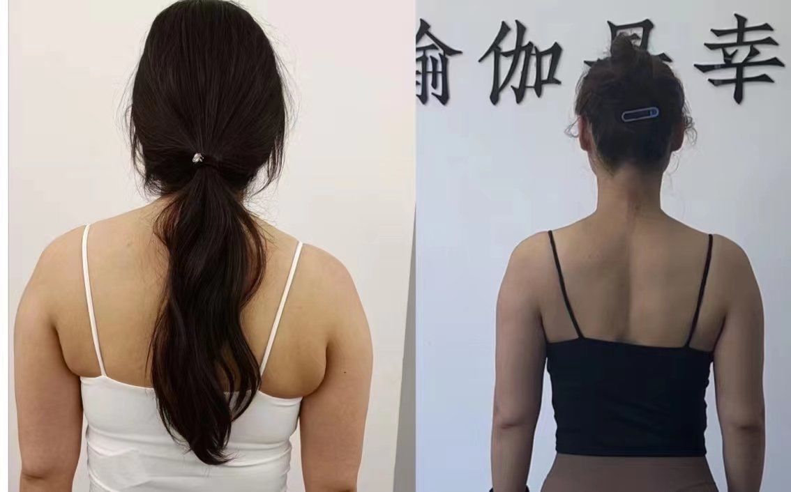 美背杀 直角肩天鹅颈蝴蝶背原来是种病
