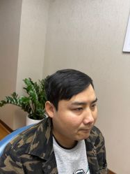 体验后-大麦微针植发全国连锁