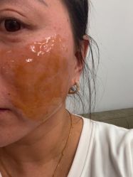 体验后-青岛诺德医学美容医院