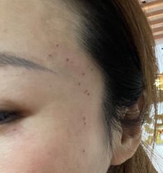 -痣清宫祛斑祛痣连锁店