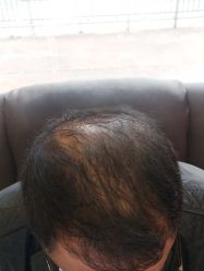 -碧莲盛·不剃发植发