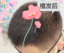 -大麦微针植发全国连锁