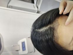 体验后-大麦微针植发全国连锁