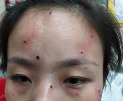 体验前-北京美痣堂古方祛痣斑疣瘊