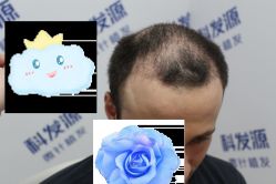 -大麦微针植发丨全国连锁
