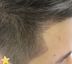 -大麦微针植发丨全国连锁