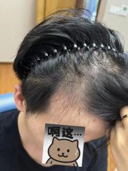 -大麦微针植发全国连锁