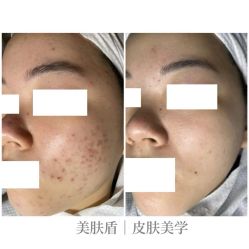 -美肤盾祛痘·问题肌头疗管理中心