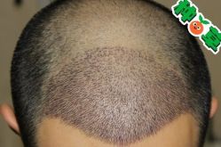 -大麦微针植发丨全国连锁