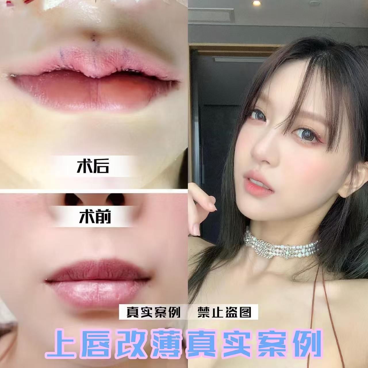 君美施医疗整形:唇综合