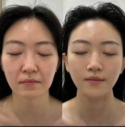 体验前-深圳鹏爱秀琪医疗美容医院
