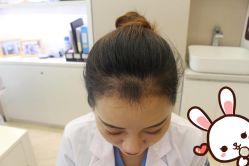 点击看大图 -大麦微针植发丨全国连锁