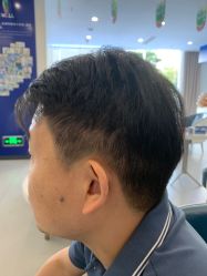 点击看大图 体验后-大麦微针植发全国连锁