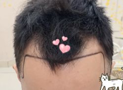 -大麦微针植发全国连锁