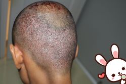 -大麦微针植发丨全国连锁