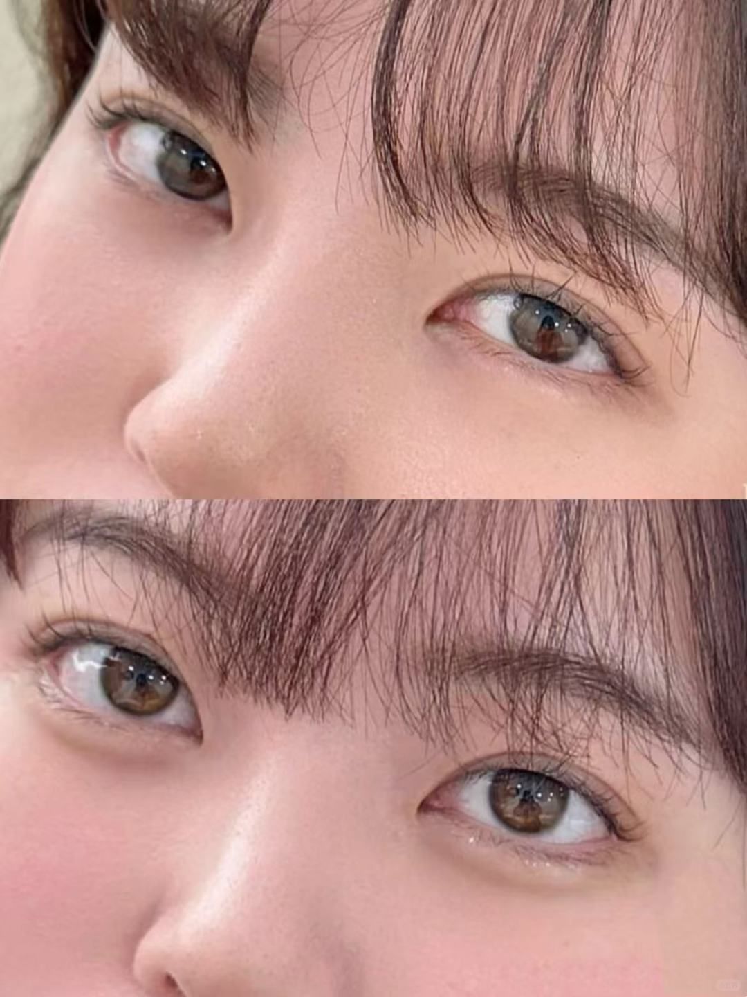 医美小白biu卧蚕 后悔没早点打!