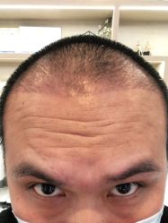 -大麦微针植发丨全国连锁