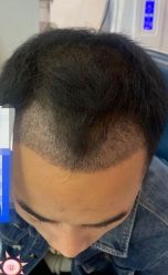 -大麦微针植发丨全国连锁