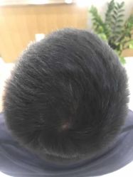 -大麦微针植发全国连锁