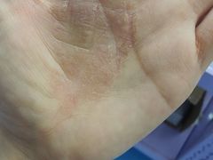 -祖传修脚甲沟炎灰指甲鸡眼