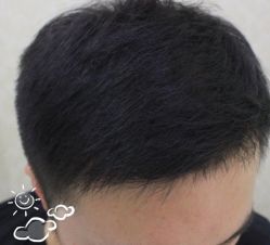 -大麦微针植发丨全国连锁