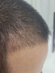 点击看大图 体验后-碧莲盛·不剃发植发
