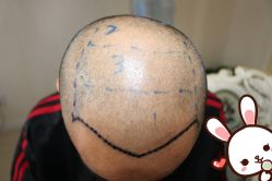 -大麦微针植发丨全国连锁