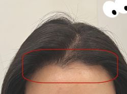 -大麦微针植发全国连锁