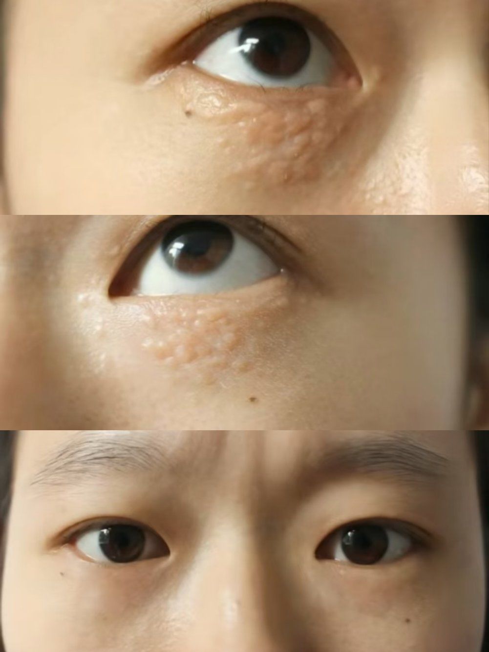 汗管瘤一般长在眼周,成凸起丘疹