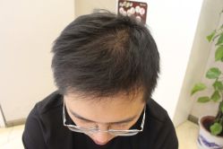 点击看大图 -大麦微针植发丨全国连锁