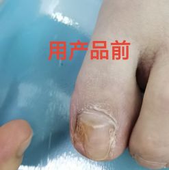-德哥灰指甲脚气甲沟炎跖疣护理
