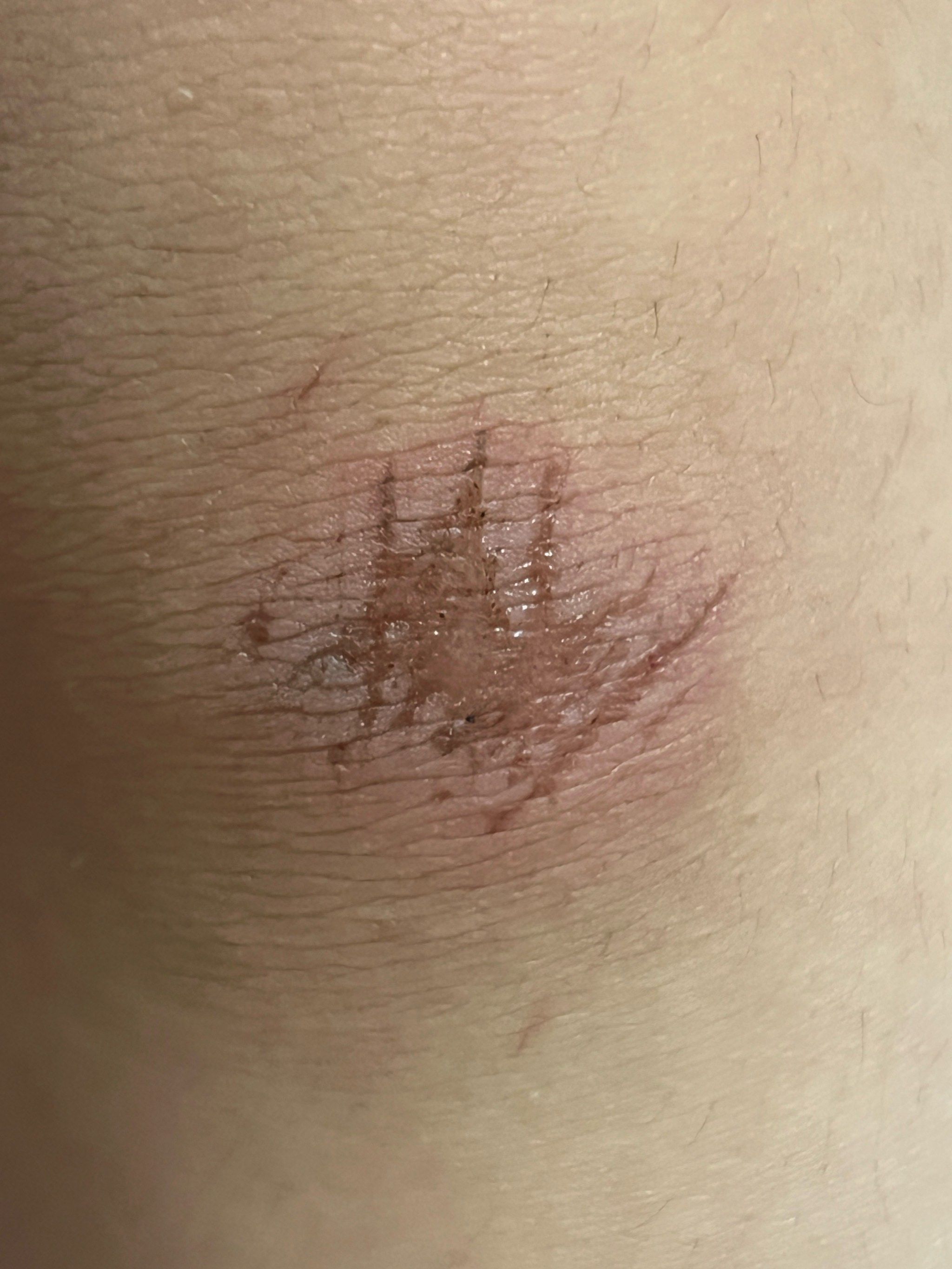 小伤口的治疗秘诀