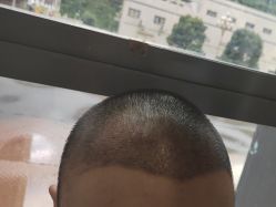 -碧莲盛·不剃发植发