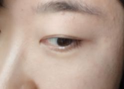 体验后-坤如玛丽·医疗美容中心