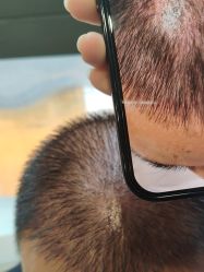 -碧莲盛·不剃发植发