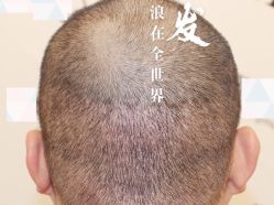 -大麦微针植发全国连锁