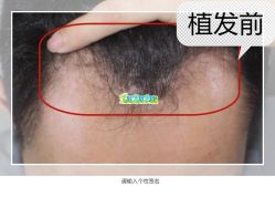 -大麦微针植发全国连锁