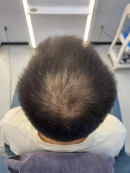 -大麦微针植发全国连锁