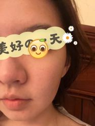 体验后-正璞医疗美容·皮肤修复·微整注射