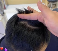 -大麦微针植发丨全国连锁