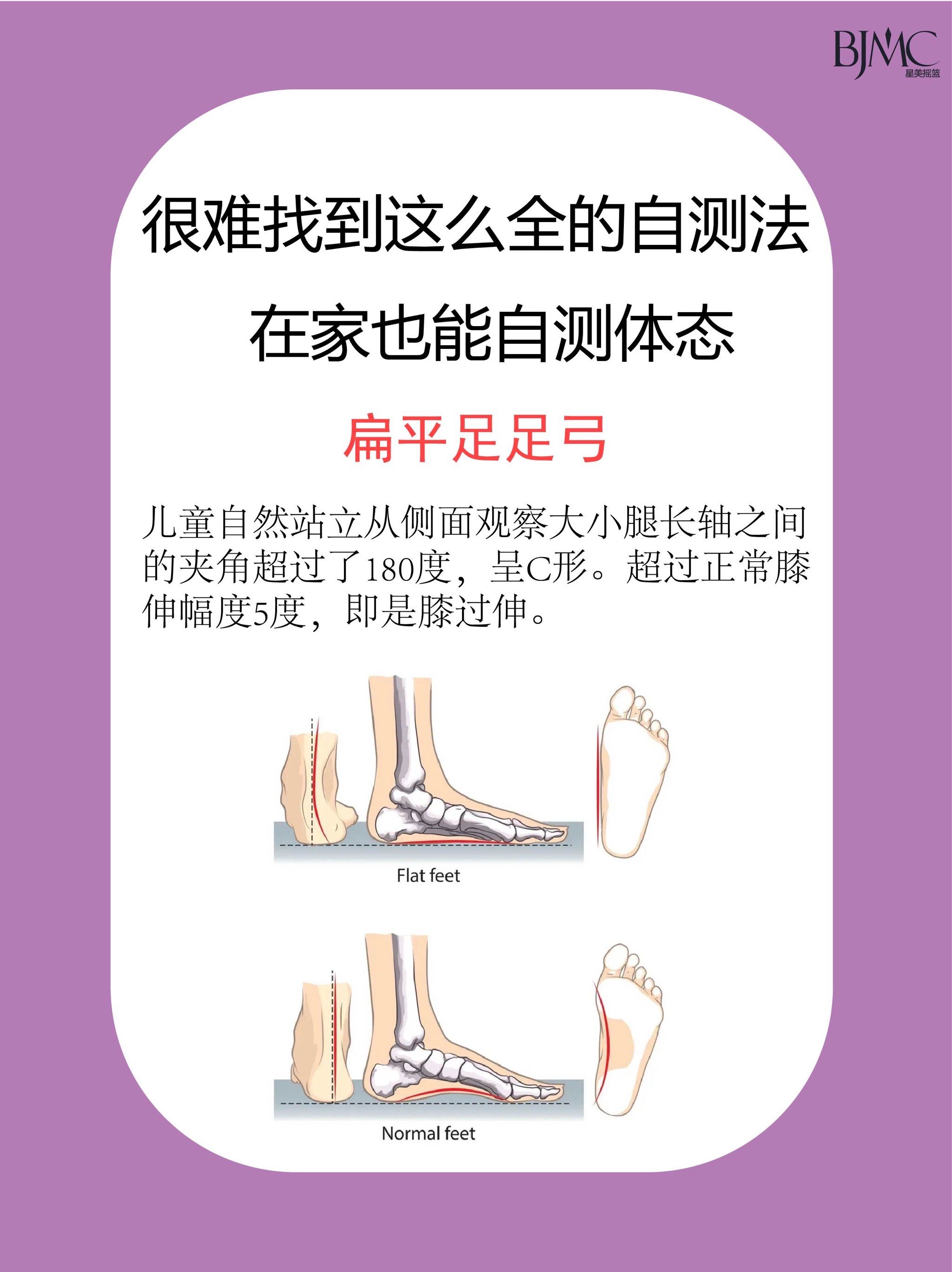 在家也能自测体态 今日分享——扁平足足弓自测方法