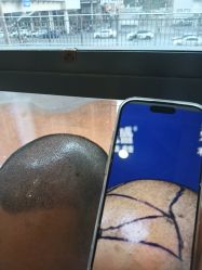 -碧莲盛·不剃发植发