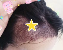 -大麦微针植发全国连锁