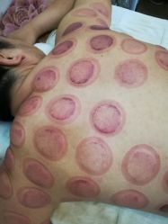 -苗塑堂减肥艾灸