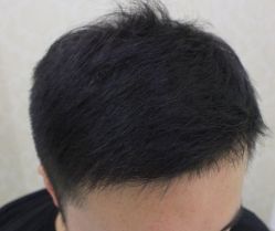 -大麦微针植发全国连锁