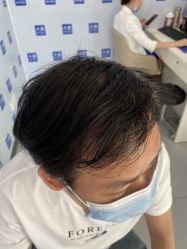 点击看大图 体验后-大麦微针植发全国连锁