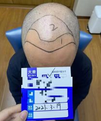 -大麦微针植发全国连锁